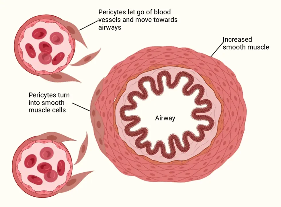 Asthmatic lung structure